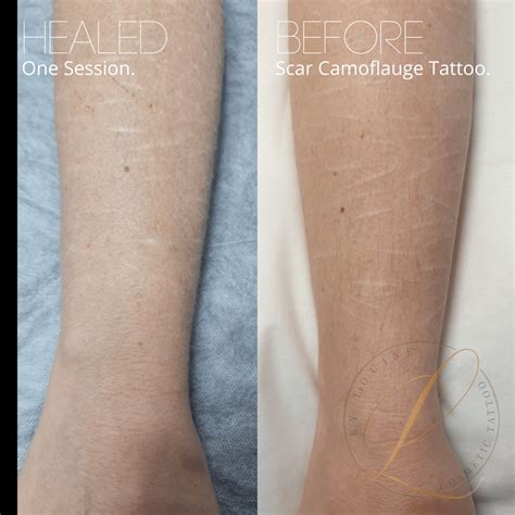 Scar Camouflage Tattoo Solutions for Flawless Skin