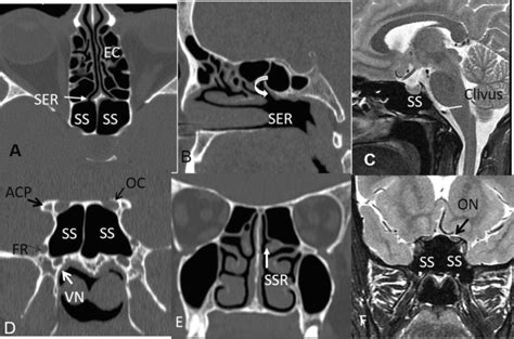 Sphenoid Sinus Anatomical Variants And Pathologies Pictorial Essay Neuroradiology