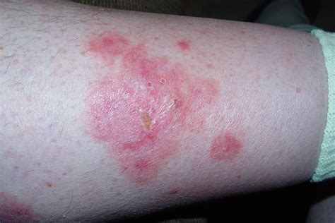 Spider Bite Rash