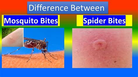 Spider Bite Vs Mosquito Bite Outdoor Pests