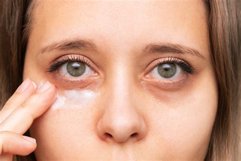 Sunken Eyes Enophthalmos Causes Treatment Remedies Faq