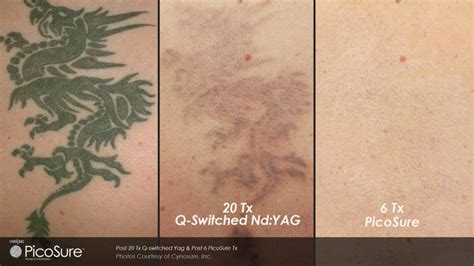 Tattoo Removal Cost How Much Does It Cost To Remove A Tattoo 207 Laser Amp Integrative Med