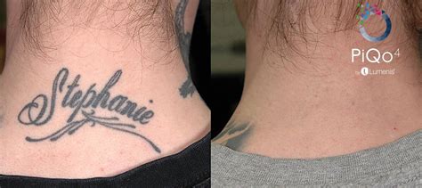 Tattoo Removal Cost Thoughtful Tattoos