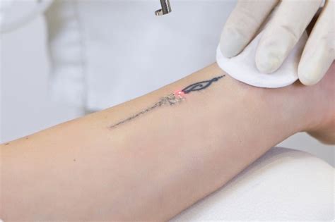 Effective Tattoo Removal in London Made Easy