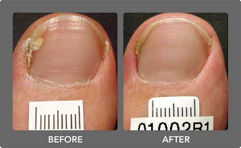 Toenail Fungus Laser Treatment Boca Raton Podiatrist