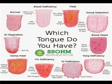 Tongue Diseases And Disorders Pictures Explained By Dr R K Aggarwal Tongue Health Tongue