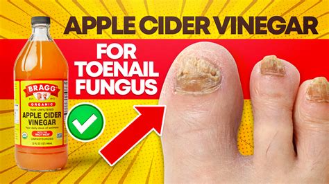 Treating Toenail Fungus With Vinegar Toenail Fungus Treatment Toenail Fungus Treatment