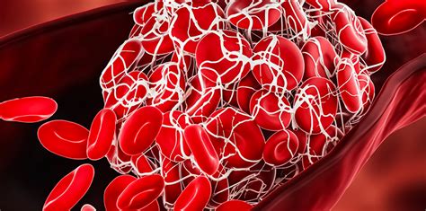 Types And Causes Of Blood Clots