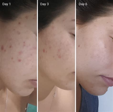 Vitamin C For Acne Scars Efficacy How It Works Before And Afters