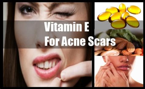 Vitamin E For Acne Scars Vitamin E Oil Cream Capsules Pills For Acne Scars How To Use