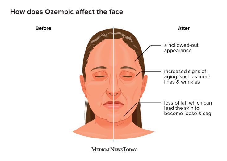 What Is Ozempic Face And How To Fix It Aestha Clinic